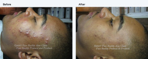 inflamed_acne_hyperpigmentation_small