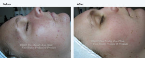 noninflamed_acne_small
